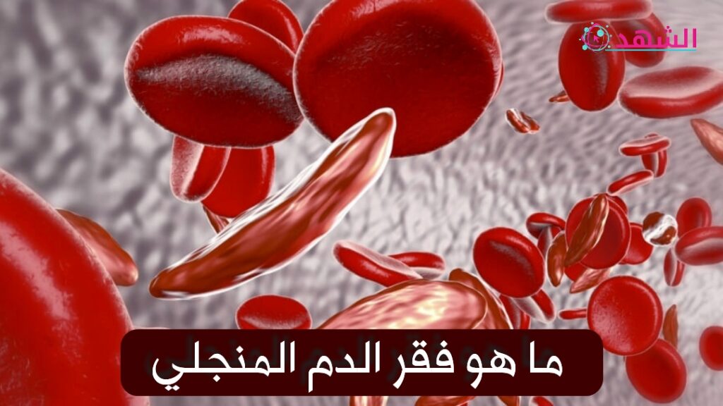 ما هو فقر الدم المنجلي