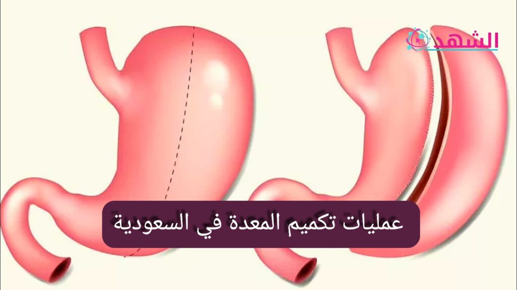 عمليات تكميم المعدة في السعودية